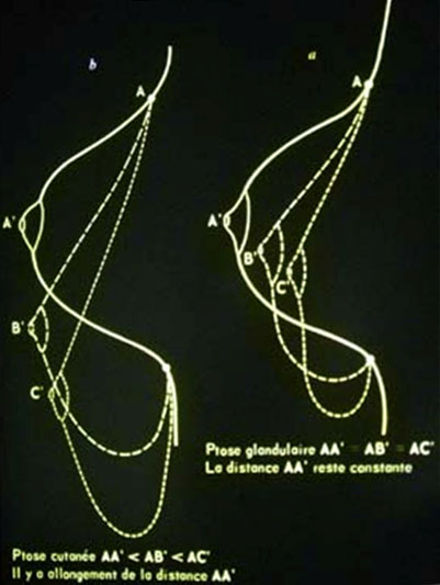 Les diff&eacute;rents niveaux de ptose mammaire