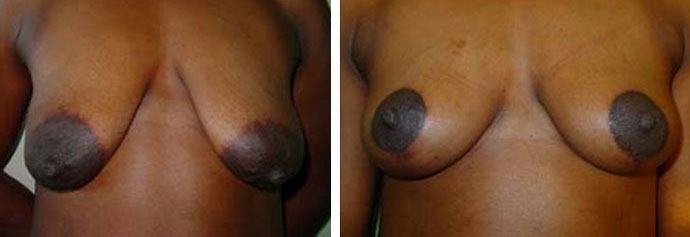 Photo de lifting des seins avant apr&egrave;s