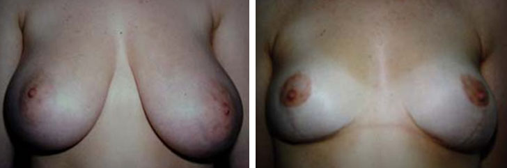 Photo de r&eacute;duction mammaire avant apr&egrave;s