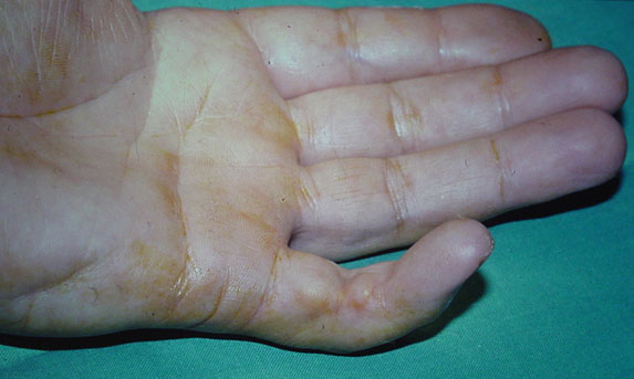 Photo de r&eacute;tractation digitale caus&eacute;e par la maladie de Dupuytren