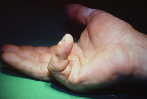 R&eacute;traction digitale caus&eacute;e par la maladie de Dupuytren