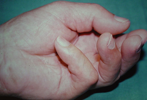 R&eacute;traction digitale caus&eacute;e par la maladie de Dupuytren