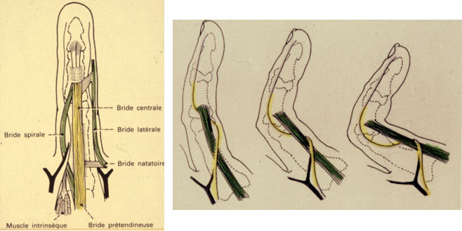 Sch&eacute;ma Dupuytren